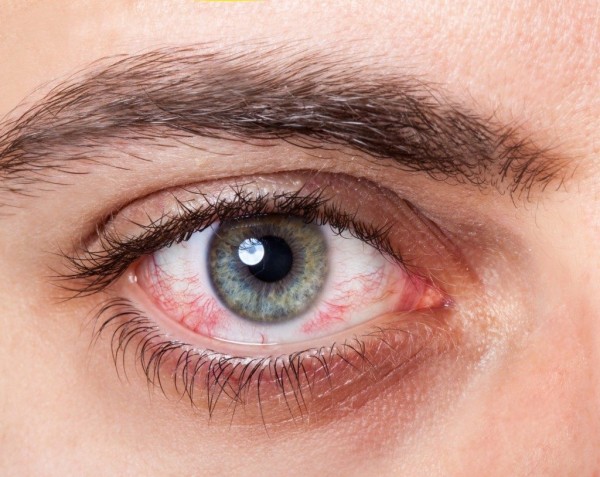 dry eyes (4)