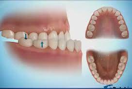 ناهنجاری آندربایت