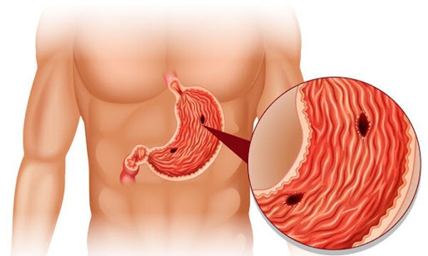 عجیبترین علائم ابتلا به زخم معده؛ از مدفوع سیاه و آروغ زدن تا نفخ معده و استفراغ خونی عجیبترین علائم ابتلا به زخم معده؛ از مدفوع سیاه و آروغ زدن تا نفخ معده و استفراغ خونی