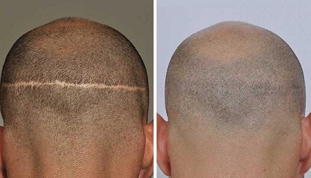 عوارض کاشت مو به روش fut, بهترین روش کاشت مو, کاشت واحدهای فولیکولی