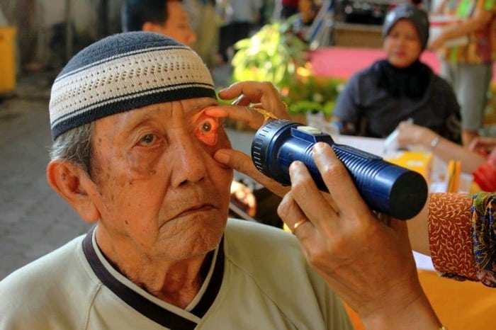 انواع آب مروارید چشم انواع آب مروارید