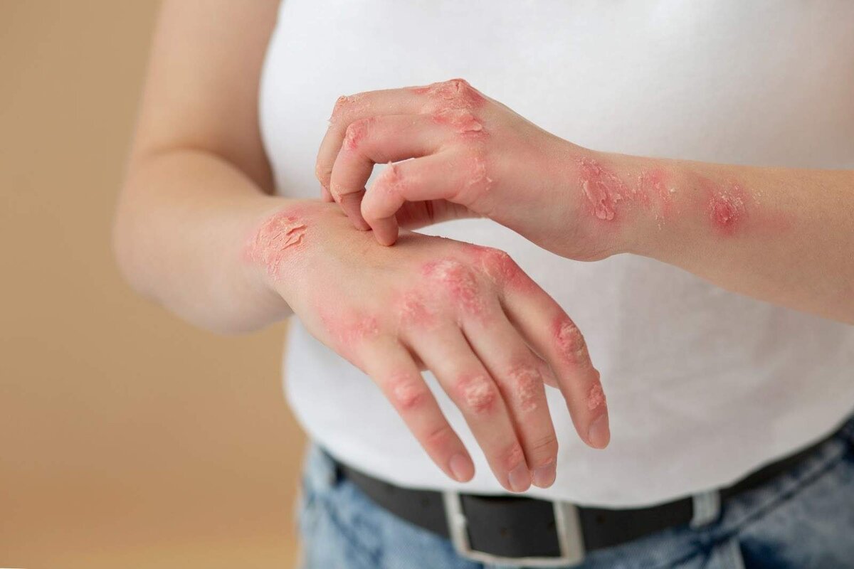 اگزما چیست؟ | علل، علائم، انواع، درمان و پیشگیری + تصاویر اگزما
