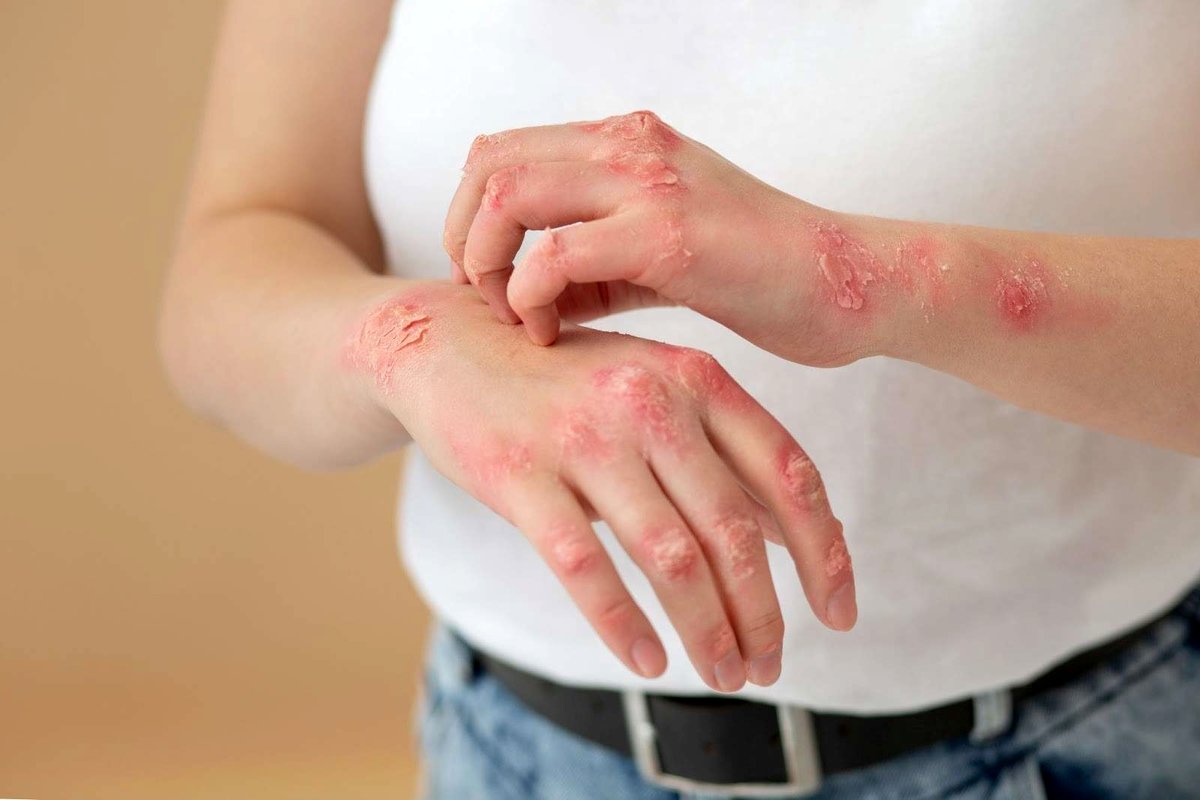 اگزما چیست؟ | علل، علائم، انواع، درمان و پیشگیری + تصاویر اگزما
