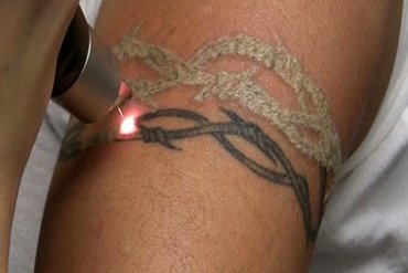 آیا تاتو پاک شدنی است؟!