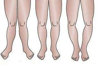 مبتلایان به پای "ضربدری"، درمان را با ساده ترین حرکات اصلاحی شروع کنند