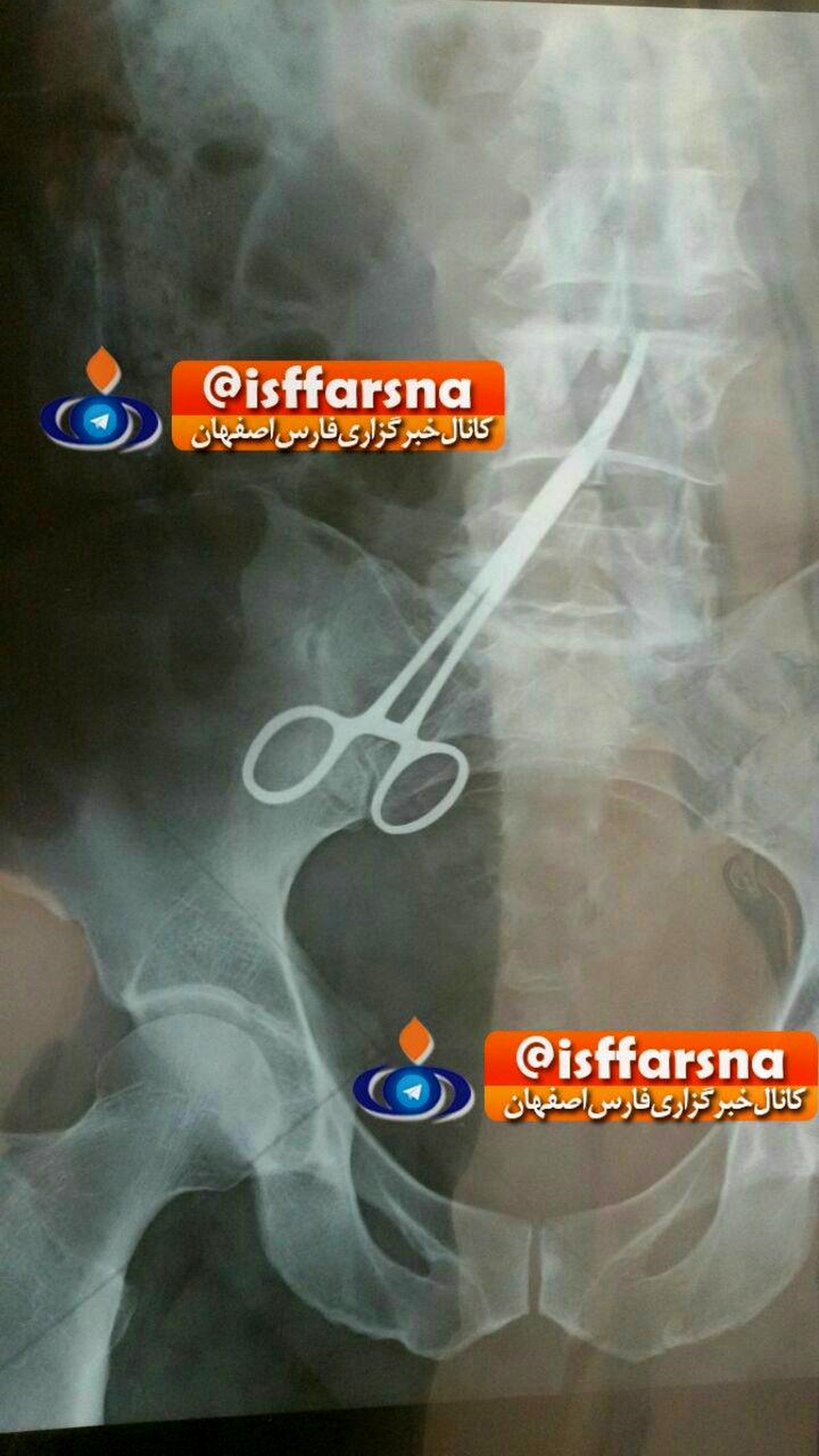 جا ماندن پنس در شکم بیمار زواره‌ای !