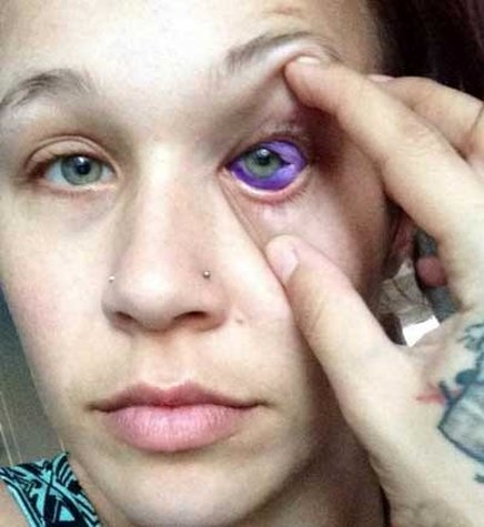 نابینایی احتمالی دختر به علت عملی احمقانه!