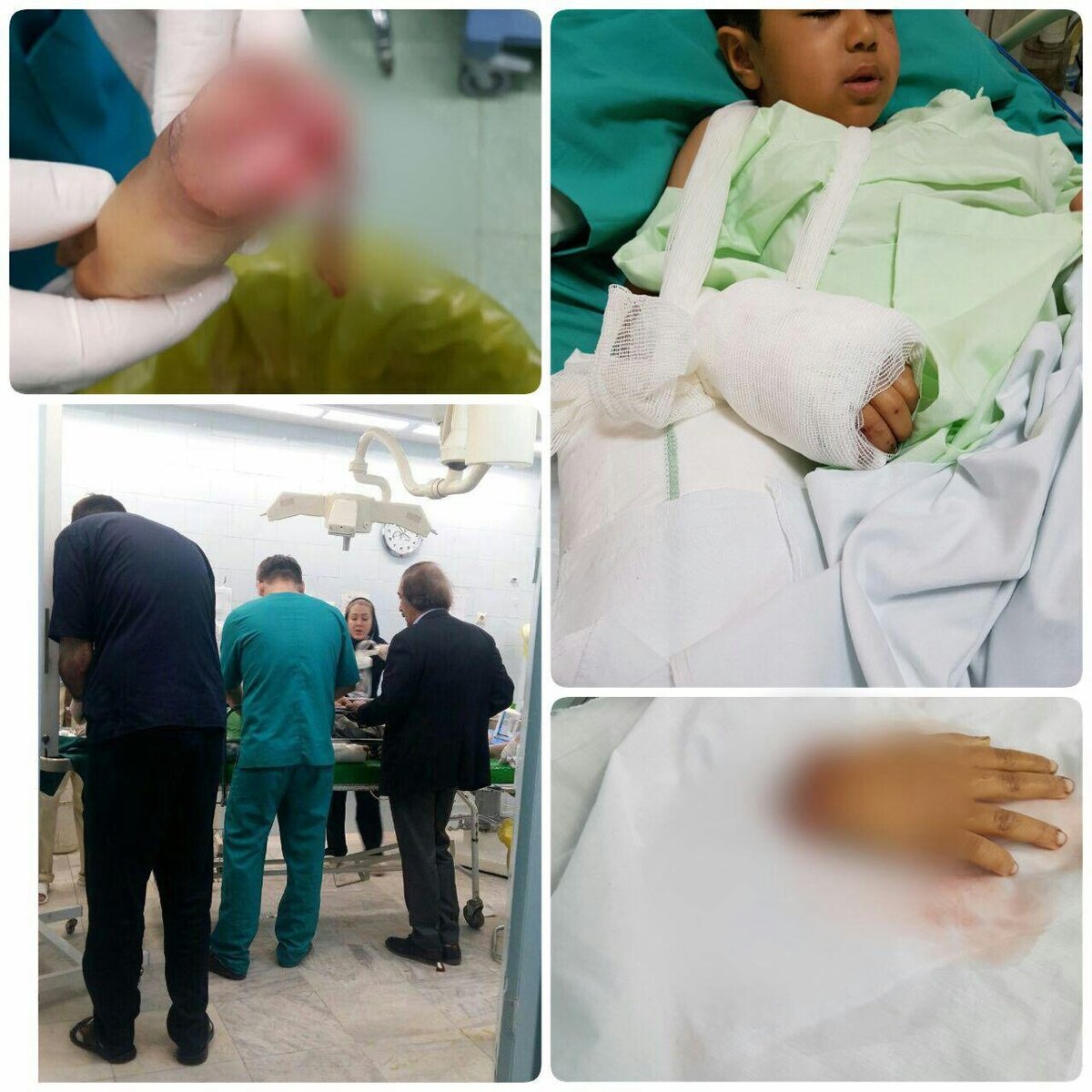 پیوند دست قطع‌شده کودک زلزله‌زده