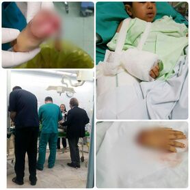 پیوند دست قطع‌شده کودک زلزله‌زده
