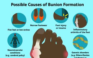 انحراف شست پا (bunion) از علائم تا درمان