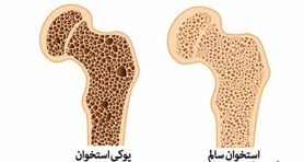 علل پوکی استخوان چیست؟