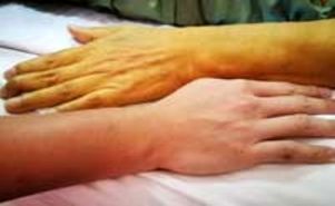 چرا رنگ پوستمان زرد می شود؟