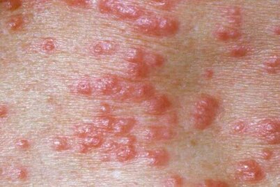 علائم پوستی بیماری کرونا چیست؟