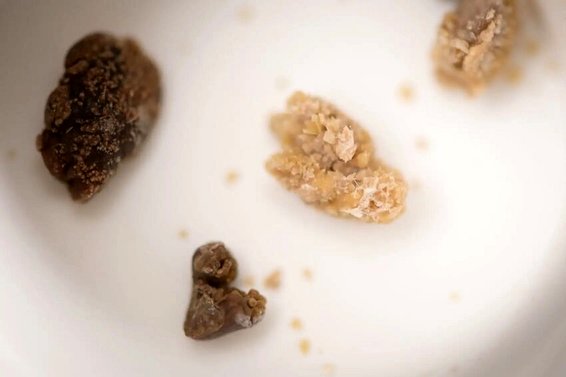 سنگ کلیه چگونه درمان می‌شود؟