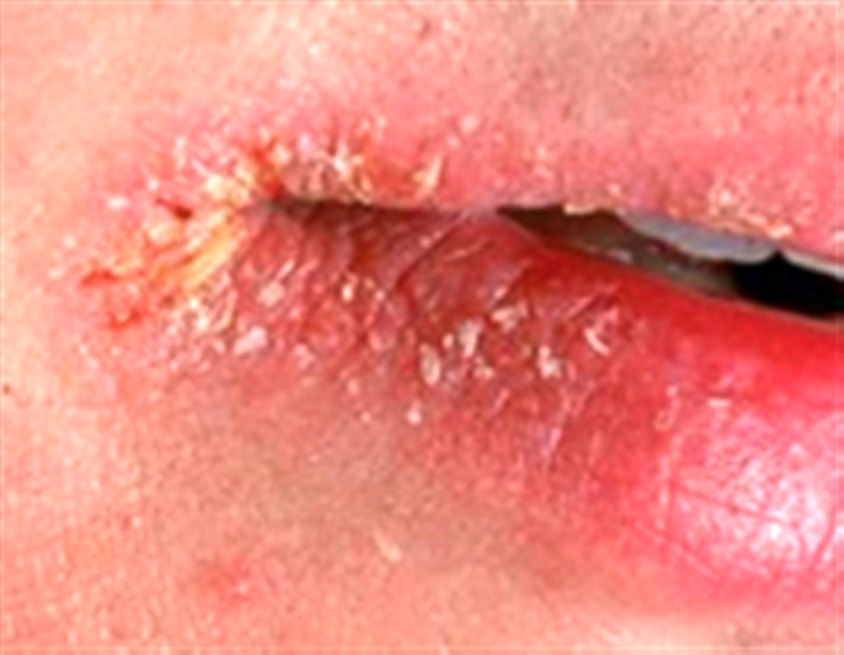 چرا گوشه لب‌ها ترک می‌خورد؟