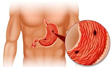 علائم ابتلا به زخم معده