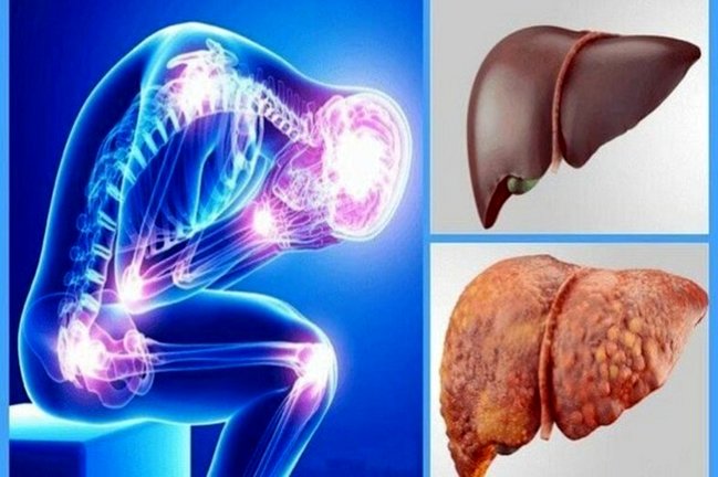 یک روش ساده گیاهی برای درمان «کبد چرب»