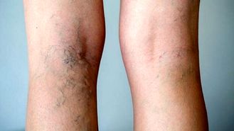 عادت‌های غلطی که نمی‌دانستید باعث واریس می‌شوند