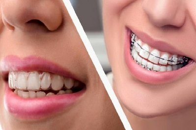 همه چیز در مورد ارتودنسی نامرئی