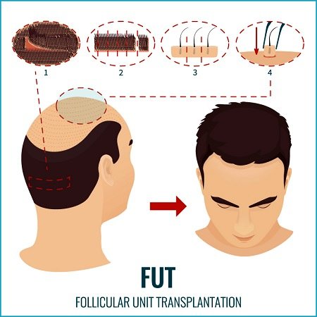 کاشت مو به روش FUT : مزایا ، عوارض جانبی ، نحوه کار