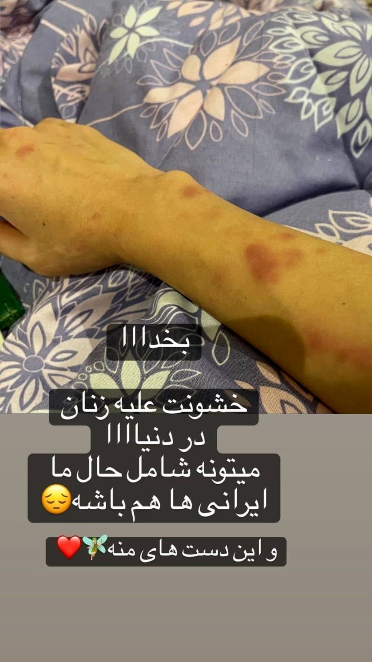 “نفیسه روشن” مورد ضرب و شتم و خشونت خانگی قرار گرفت! + عکس دست کبود وی