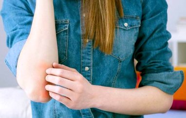 علائم پسوریازیس (صدف) ، شایع ترین بیماری پوستی