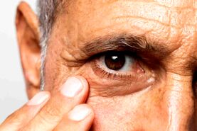 پیرچشمی چیست و چگونه درمان می‌شود؟ | علائم، علل و راهکارهای مؤثر