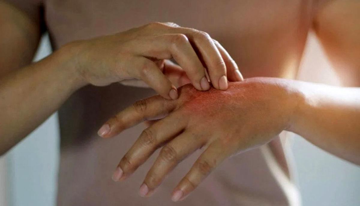 پورفیری چیست؟ علائم، علل، انواع، عوارض و درمان بیماری پورفیری را بشناسید